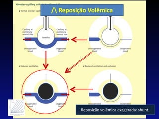 / Reposição Volêmica
PVM
Reposição volêmica exagerada: shunt.
 