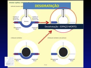 DESIDRATAÇÃO
PVM
Desidratação : ESPAÇO MORTO.
 