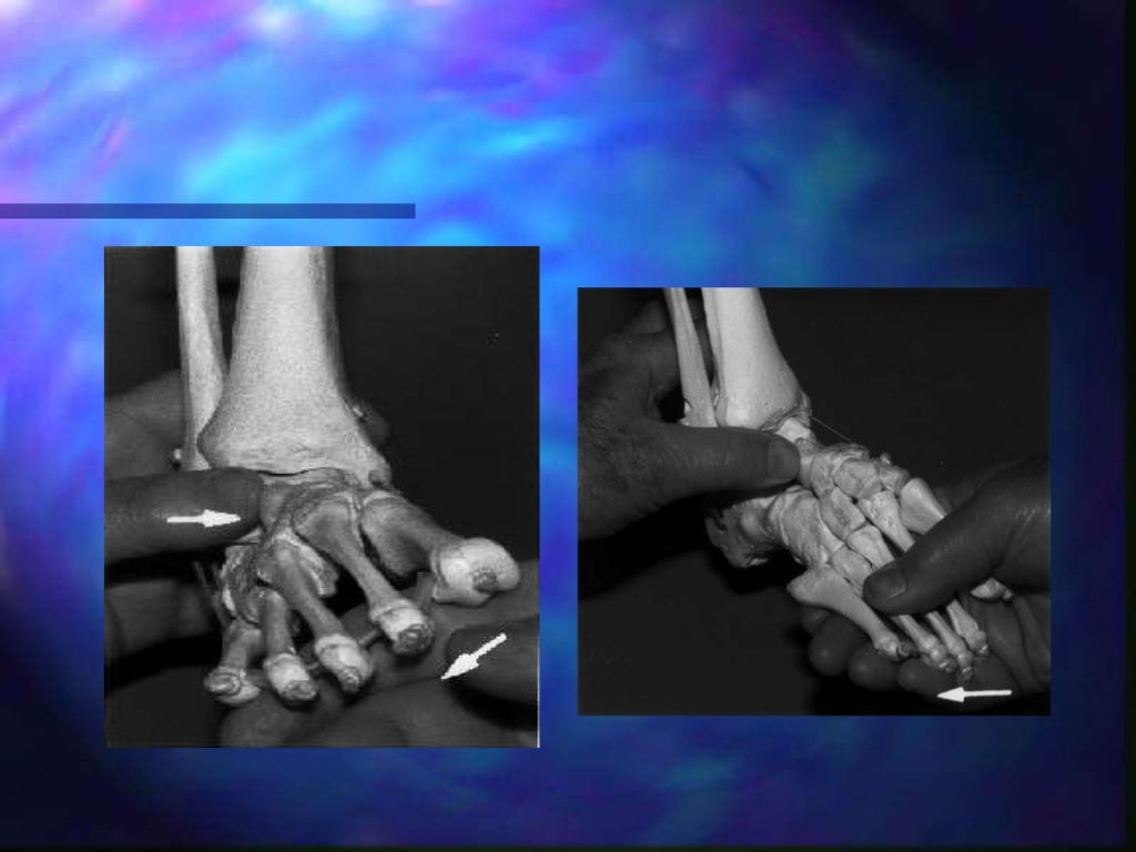 Pe equino varo aducto congenito