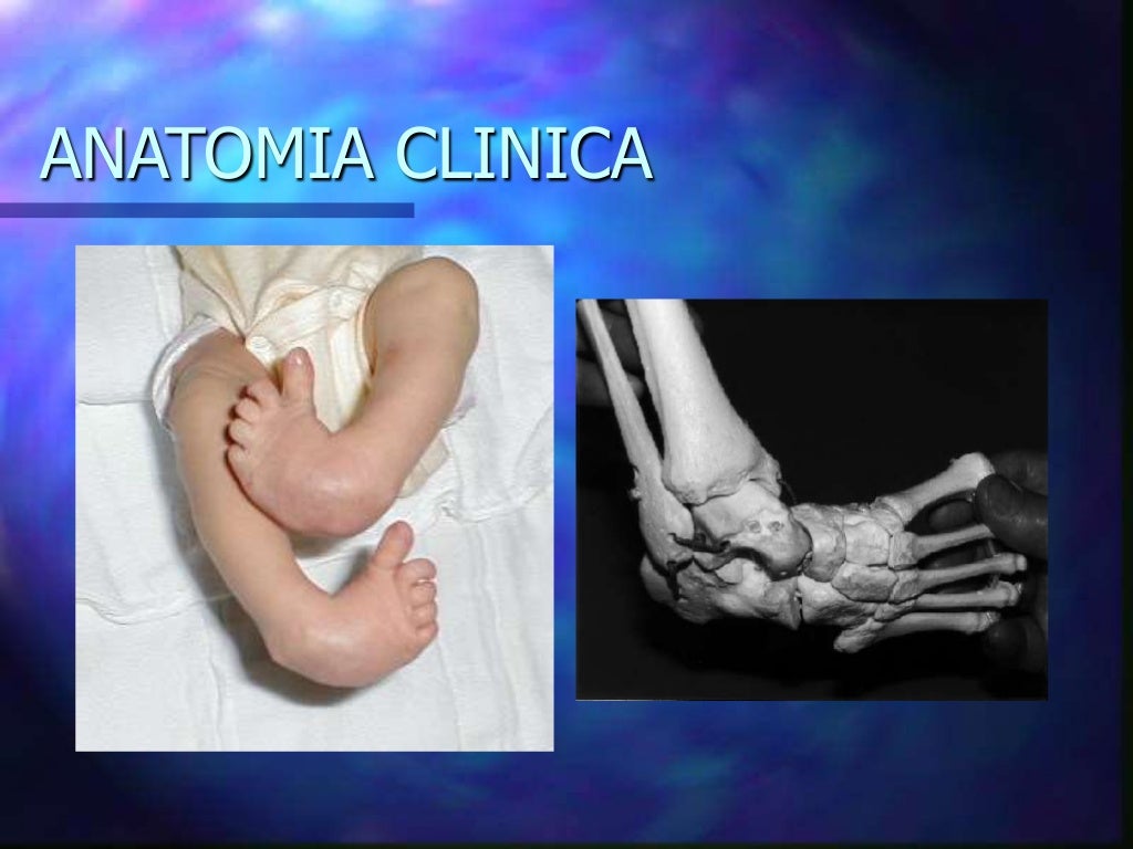 Pe equino varo aducto congenito