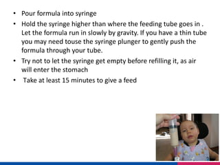 • Pour formula into syringe
• Hold the syringe higher than where the feeding tube goes in .
Let the formula run in slowly by gravity. If you have a thin tube
you may need touse the syringe plunger to gently push the
formula through your tube.
• Try not to let the syringe get empty before refilling it, as air
will enter the stomach
• Take at least 15 minutes to give a feed
 