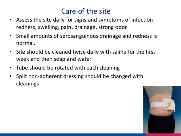 Caring for a peg tube