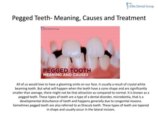 PEGGED TEETH MEANING CAUSES AND TREATMENT PPTX Dental Health PEGGED TEETH MEANING CAUSES AND TREATMENT 1 320