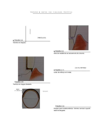 PREPAROS K DENTES Í o i: FINALIDADE PROTETICA
PORCfcLANA
• FIGURA 3.8
Término em degrau.
FIGURA 3.10
Término em degrau biselado.
FIGURA 3.9
Área de resistência ao escoamento do cimento.
(OLRi>: REFORÇO
FIGURA 3.11
Colar de reforço em metal.
Dllik I
FIGURA 3.12
Preparo para metalocerâmica - término cervical
dade de desgaste.
quanti-
 