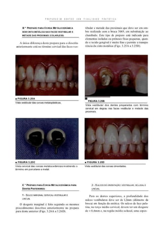 M E P U O S DE D E I I E S COM F I N A L I D A D E P RO I É I I C *
B * PREPARO PARA COROA METALOCERÀMICA
SEM CINTA METÁLICA NAS FACES VESTIBULAR E
METADE DAS PROXIMAIS [COLARLESS)
A única diferença desle preparo para o descrito
antcriomicnle está no termi IH» cervical das faces ves-
• F I G U R A 3 . 2 5 A
Vista vestibular das coroas metaloplásticas
no
tibular e metade das proximais que deve ser em om-
bro realizado com a broca 3069, em substituição ao
chanfrado. Este tipo de preparo está indicado para
elementos isolados ou próteses fixas pequenas, quan-
do o tecido gengival é muito fino e permite a transpa-
rência da cinta metálica (Figs. 3.25A a 3.25D).
F I G U R A 3 . 2 5 B
Vista vestibular dos dentes preparados com término
cervical em degrau nas faces vestibular e metade das
proximais.
• F I G U R A 3 . 2 5 C • F I G U R A 3 . 2 5 D
Vista cervical das coroas metalocerâmicas mostrando o Vista vestibular das coroas cimentadas
término em porcelana e metal.
C " PREPARO PARA COROA METALOCERÀMICA PARA
DENTES POSTERIORES:
1 - SULCO MARGINAL CERVICAL-VESTISULAR E
LINCIW.
O desgaste marginal ê feito seguindo os mesmos
procedimentos descritos anteriormente no preparo
para dente anterior (Figs. 3.26A a 3.26D).
2- SULCOS DE ORIENTAÇÃO: VESTIBULAR, OCLUSAL E
UNCUAL
Para os dentes superiores, a profundidade dos
sulcos vestibulares deve ser de l,2mm (diâmetro da
broca) em função da estética. Os sulcos da face pala-
tina, no terço médio cervical, devem ter um desgaste
de ± 0,6mm e, na região médio oclusal, uma espes-
 
