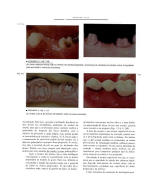 PIO J IA
• f IGURAS 3 IAE ) IB
lA)Vista vestferiar dlmca e(B) no modelo doa o****» preparados. Aores.
para aumenta» a f»t«oçfto da prótese.
eanponanie
n a J C
a FIGURAS 3.IBa 3.1 D
(C)Vtsiasocluaaldomodetode uaoa no a (D), do caso concluído.
*ua retcncio. Para iiio. a po* icio c ínclinacio do. dente» no
arco devem MX. inicialmente. anab>ada> em modelo de
aludo, paia que o pcoTiuioa •) possa controlar melhor a
qualidade dc de.f a.K das face* dentária* COM O
oèfctlto de preservai a .ande palpar, sem. porem, perder
«caiaeKrúiKaidvieltfiKJoííWéCica. "X A picaenaejo c
a manulcncio da vitalidade pulpar devem «rmpie icr o
ofcjclivo principal dc qualquer dente pieparado. At v«»».
iuo nio é poulvcl devido ao grau de Ínclinacio dos
denic*. Porem, cise ittco tempte seca diminuído com a
anal k H prév ia no —'tília át • • i à i I 11 lllll l l i l i i r j i i f i i
Apos o prepaio do, dentei, l i / - uma molda*cm
com aleinalo < avalia-** o paralelismo caire O. de«lei
preparados no modelo dv poso. Pan U M . delimita-ve
com grafite a juneao da. paredes axiau com a itengival
de lodoi o» dente, pi, I) opciadoi deve
visualizai ioda a marca de grafilc em todo, o, dente.
pieparadoa com apenas um do> olho. e a uma dislin-
cia aproximada de ÍOcm. Se i.io nio ocorrer, exiiicm
área» rcicntivai no preparo < Fifi. • .' 
A arca do preparo e >ua levlura ••pcrficiai tio as-
pecto, lambem importantes na Kicacno. quanio mai-
or a área preparada, maior será a retcncio No* dente*
que .e apreentam cariados ou rolauradot. as caixas
proveniente, da i ela uracáo também SÊÊÍmm capaci-
dade' ictcntiva ao preparo. A*»im. meios adicionais de
letciw» V.UV1- cdiialcU*. pui.". ,«ill.io.. m . sio
importante» paia compensai I. .. .• tipo de defici-
êaeia cxiilcafc ao denlc a ser preparado
Em reboto á tentara saperfkial lem qn* *e consi-
derar que a capacidade de ade.au do. cimento, denia-
i i . " depende basicamente do eonialo deite, com a.
microrrclcncoc, existente, na> .upeitkici do dente
pieparado e da prólcic.
Como a maioria dos mater iai. de moldagem apre-
 