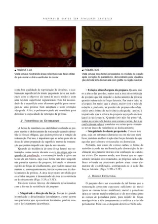 P R E P A R O S OE D E N T E S C O U F I N A L I D A D E P A O I É T I C A
• F I G U R A 3 . 2 A
Vista oclusal mostrando áreas retentivas nas faces distai
do pré-molar e disto-vestibular do molar
ai F I G U R A 3.2B
Vista oclusal dos dentes preparados no modelo de estudo
após correçâo do paralelismo, demonstrado pela visualiza-
ção de toda linha demarcada com grafite na regâocervicaí.
senta boa qualidade de reprodução de detalhes, o aca-
bamento superficial do dente preparado deve ser reali-
zado com o objetivo de torná-lo mais nítido e com
uma textura superficial regularizada. Não há necessi-
dade de a superfície estar altamente polida para conse-
guir-se uma prótese bem adaptada e com retenção
adequada. Aliás, o polimento pode até contribuir para
diminuir a capacidade de retenção da prótese.
2 RESISTÊNCIA OU ESTABILIDADE
A forma de resistência ou estabilidade conferida ao pre-
paro previne o deslocamento da restauração quando subme-
tida às forças oblíquas, que podem provocar a rotação da
restauração. Por isso. é impoitante que se saiba quais são as
áreas do dente preparado da superfície interna da restaura-
ção que podem impedir este tipo de movimento.
Quando da incidência de uma força lateral na res-
tauração, como ocorre durante o nca ma.stigar.orjo ou
quando há parafunção. a restauração tende a girar em
torno de um fulcro, cujo raio forma um arco tangente
nas paredes opostas do preparo, deixando o cimento
sujeito às forças de cisalhamento. que podem causar sua
ruptura e. consequentemente, iniciar o processo de des-
locamento da prótese. A área do preparo envolvida por
esta linha tangente ê denominado de área de resistência
ao deslocamento (Figs. 3.3A a 3.3C).
Existem vários fatores diretamente relacionados
com a forma de resistência do preparo:
- Magnitude e direção da força. Forças de grande
intensidade e direcionadas lateralmente, como ocorre
nos pacientes que apresentam bruxismo. podem cau-
sar o deslocamento da prótese;
- Relação altura/largura do preparo. Quanto mai
or a altura das paredes, maior será a área de resistência
do preparo que irá impedir o deslocamento da prótese
quando submetida às forças laterais. Por outro lado. se
a largura for maior que a altura, maior será o raio de
rotação e. portanto, as paredes do preparo não ofere
ceráo uma forma de resistência adequada. Assim, é
importante que a altura do preparo seja pelo menos
igual àsua largura. Quando isto não for possível.
uinu nos casos dc tk-.Ho u . m wuroas uirlas, d . u ^ c
confeccionar sulcos, canaletas ou caixas para criarem-
se novas áreas de resistência ao deslocamento;
- Integridade do dente preparado. Coroas ínte
gras, seja em estruturas dentárias ou em núcleos metá
licos. resistem melhor à açáo das forças laterais do que
aquelas parcialmente restauradas ou destruídas.
Portanto, nos casos de coroas curtas, a forma de
resistência pode ser melhorada pela diminuição da in-
clinação das paredes laterais e/ou confecção de canale-
tas axiais. Do mesmo modo. nos dentes que se apre-
sentam cariados ou restaurados, as próprias caixas das
faces oclusais ou proximais podem atuar como ele-
mentos de estabilização, contrapondo-se à açáo das
forças laterais. (Figs. 3.3D a 3.3F)
J* RIGIOEZ ESTRUTURAL
O preparo deve ser executado de tal forma que a
restauração apresente espessura suficiente de metal
(para as coroas totais metálicas), metal e porcelana
(para as coroas metalocerarnicas) e de porcelana (para
as coroas de porcelana pura), para resistir às forças
mastigatórias e não comprometera estética e o tecido
periodontal. Para isso. o desgaste deverá ser feito sele-
 