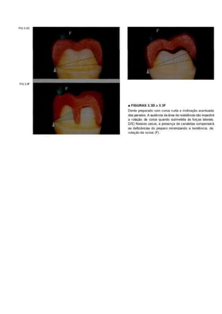 • FIGURAS 3.3Da 3.3F
Dente preparado com coroa curta e inclinação acentuada
das paredes. A ausência da área de resistência não impedirá
a rotação da coroa quando submetida às (orças laterais.
D/E) Nesses casos, a presença de canaletas compensará
as deficiências do preparo minimizando a tendêrvcia. de.
rotação da coroa (F).
 