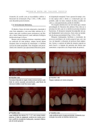 PREPAROS OE DENTES COM FINALIDADE P R O I E I I C A
tivamente de acordo com as necessidades estética e
funcional da restauração (Figs. 3.4A e 3.4B), como
será discutido posteriormente.
5 4' INTEGRIDADE MARGINAL
O obj clivo básico de toda restauração cimentada é
estar bem adaptada e com uma linha mínima de ci-
mento, para que a prótese possa permanecer em fun-
ção o maior tempo possível, num ambiente biológico
desfavorável que é a boca.
Mesmo com as melhores técnicas e materiais usados
na confecção de uma prótese, sempre haverá algum
desajuste entre as margens da restauração e o término
cervical do dente preparado. Esse desajuste será preen-
chido com cintentos que apresentam diferentes graus
de degradação marginal. Com o passar do tempo, cria-
se um espaço entre o dente e a restauração que vai
permitir, cada vez mais, retenção de placa, recidiva de
cárie e, consequentemente, perda do trabalho.
O cirurgião-dentista deve ter em mente que a maior
porcentagem de fracassos das próteses fixas deve-se á
presença da cárie, que só se instala na presença da placa
bacteriana. O desajuste marginal desempenha um pa-
pel fundamental neste processo, bem como na instala-
ção da doença periodontal (Figs. .V5A e 3.5B).
Margens inadequadas facilitam a instalação do
processo patológico do tecido gengiva! que. por sua
vez, irá impedir a obtenção de próteses bem adapta-
das. Assim, o controle da linha de cimento exposta ao
meio bucal e a higiene do paciente são fatores que
aumentam a expectativa de longevidade da prótese.
FIGURA 3.4A
Porcelana (raturada na região médio-cervical da face vesti-
bular do canino causada, provavelmente, pela flexão da
estrutura metálica muita fina nessa região.
• FIGURA 3.4B
Reparo realizado em resina composta.
FIGURA 3.5A
Vista vestibular dos dentes 10,11,21 com coroas metalo-
plásticas. A falta de adaptação, ausência de contato proxi-
mal e perfil de emergência inadequado, causaram inflama-
ção do tecido gengiva).
FIGURA 3.5B
Vista vestibular após cirurgia periodontal, mostrando a
netração da sonda na interface dente/coroa.
 