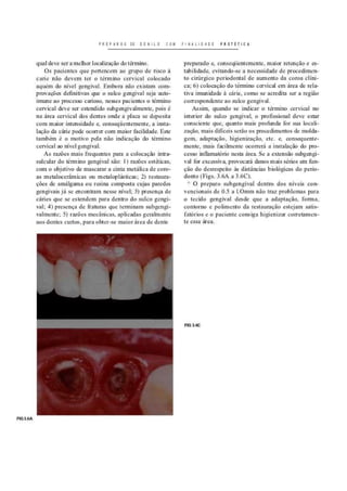 P R E P A R O S DE D E H I L S C O M F I N A L I D A D E P f i O T E T I C A
qual deve ser a melhor localização do término.
Os pacientes que pertencem ao grupo de risco à
carie não devem ter o término cervical colocado
aquém do nível gengival. Embora nao existam com-
provações definitivas que o suko gengival seja auto-
imune ao processo carioso, nesses pacientes o término
cervical deve ser estendido subgengivaimente, pois é
na área cervical dos dentes onde a placa se deposita
com maior intensidade e, consequentemente, a insta
lação da cárie pode ocorrer com maior facilidade. Este
também é o motivo pela nao indicação do término
cervical ao nível gengival.
Às razoes mais frequentes para a colocação intra-
sulcular do término gengival são: 1) razões estéticas,
com o objetivo de mascarar a cinta metálica de coro-
as metalocerãmicas ou metaloplásticas; 2) restaura-
ções de amálgama ou resina composta cujas paredes
gengivais já se encontram nesse nível; 3) presença de
cáries que se estendem para dentro do sulco gengi-
val; 4) presença de fraturas que terminam subgengi-
valmente: 5) razões mecânicas, aplicadas geralmente
aos dentes curtas, para obter-se maior área de dente
preparado e, conseqiientemente, maior retenção e es-
tabilidade, evitando se a necessidade de procedimen-
to cirúrgico periodontal de aumento da coroa clíni-
ca; 6) colocação do término cervical em área de rela-
tiva imunidade ã cárie, como se acredita ser a região
correspondente ao suko gengival.
Assim, quando se indicar o término cervical no
interior do sulco gengival, o profissional deve estar
consciente que, quanto mais profunda for sua locali-
zação, mais difíceis serão os procedimentos de molda-
gem, adaptação, higienização, etc. c consequente-
mente, mais facilmente ocorrerá a instalação do pro-
cesso inflamatório nesta área. Se a extensão subgengi-
val for excessiva, provocará danos mais sérios em fun-
ção do desrespeito às distancias biológicas do perio-
donto (Figs. 3.6A a 3.6C).
A
O preparo subgengival dentro dos níveis con-
vencionais de 0.5 a I.Omm não traz problemas para
o tecido gengival desde que a adaptação, forma,
contorno e polimento da restauração estejam satis-
fatórios e o paciente consiga higienizar corretamen-
te essa área.
 