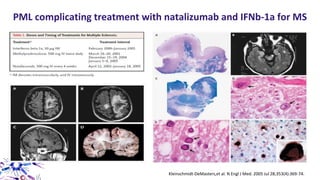 Kleinschmidt-DeMasters,et al. N Engl J Med. 2005 Jul 28;353(4):369-74.
PML complicating treatment with natalizumab and IFNb-1a for MS
 