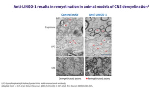 Anti-LINGO-1 results in remyelination in animal models of CNS demyelination2
LPC=lysophosphatidylcholine/lysolecithin; mAb=monoclonal antibody.
Adapted from 1. Mi S et al. Nature Neurosci. 2004;7:221-228; 2. Mi S et al. Ann Neurol. 2009;65:304-315.
1 µm
Control mAb Anti-LINGO-1
1 µm
Cuprizone
LPC
Demyelinated axons
*Remyelinated axons
EAE
 