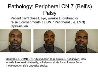 Pathology: Peripheral CN 7 (Bell’s)
Palsy
Central (i.e. UMN) CN 7 dysfunction (e.g. stroke) - not shown: Can
wrinkle forehead bilaterally; will demonstrate loss of lower facial
movement on side opposite stroke.
Patient can’t close L eye, wrinkle L forehead or
raise L corner mouthL CN 7 Peripheral (i.e. LMN)
Dysfunction
 