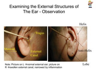 Examining the External Structures of
The Ear - Observation
Tragus
External
Canal
Helix
Anti-Helix
Lobe
Mastoid
Note: Picture on L normal external ear; picture on
R swollen external canal, narrowed by inflammation
 
