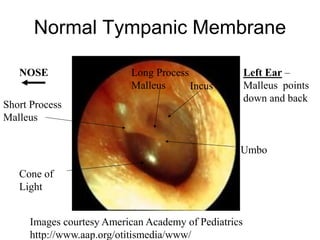 Normal Tympanic Membrane
Images courtesy American Academy of Pediatrics
http://www.aap.org/otitismedia/www/
Cone of
Light
Umbo
Short Process
Malleus
Long Process
Malleus Incus
NOSE Left Ear –
Malleus points
down and back
 