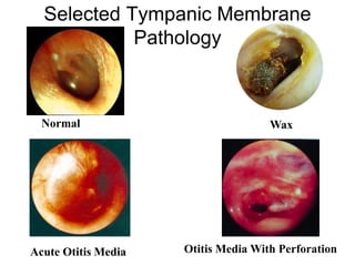 Selected Tympanic Membrane
Pathology
Acute Otitis Media Otitis Media With Perforation
Normal
WaxNormal
 