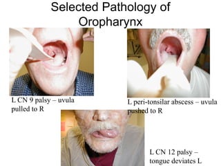 Selected Pathology of
Oropharynx
L CN 9 palsy – uvula
pulled to R
L peri-tonsilar abscess – uvula
pushed to R
L CN 12 palsy –
tongue deviates L
 