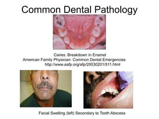 Common Dental Pathology
Caries: Breakdown in Enamel
American Family Physician: Common Dental Emergencies
http://www.aafp.org/afp/20030201/511.html
Facial Swelling (left) Secondary to Tooth Abscess
 