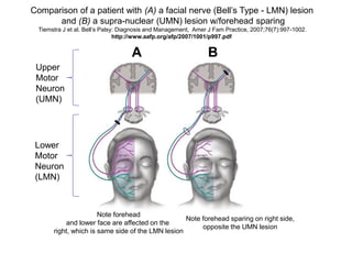 Comparison of a patient with (A) a facial nerve (Bell’s Type - LMN) lesion
and (B) a supra-nuclear (UMN) lesion w/forehead sparing
Tiemstra J et al. Bell’s Palsy: Diagnosis and Management, Amer J Fam Practice, 2007;76(7):997-1002.
http://www.aafp.org/afp/2007/1001/p997.pdf
Note forehead
and lower face are affected on the
right, which is same side of the LMN lesion
Note forehead sparing on right side,
opposite the UMN lesion
Upper
Motor
Neuron
(UMN)
Lower
Motor
Neuron
(LMN)
A B
 