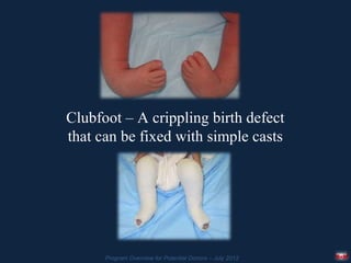 Clubfoot – A crippling birth defect
that can be fixed with simple casts




      Program Overview for Potential Donors – July 2012
 