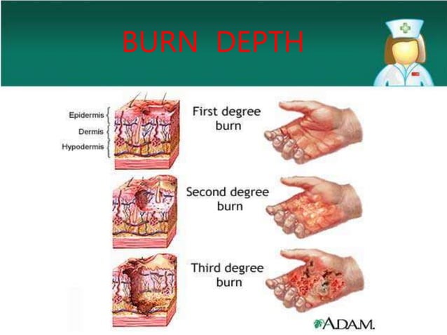 Peioperative Anaesthesia Management of Burn Patients.pptx | First Aid ...