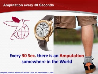 Amputation every 30 Seconds
Every 30 Sec. there is an Amputation
somewhere in the World
The global burden of diabetic foot disease. Lancet. Vol 366 November 12, 2005
 