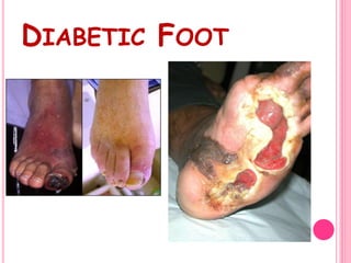 DIABETIC FOOT
 