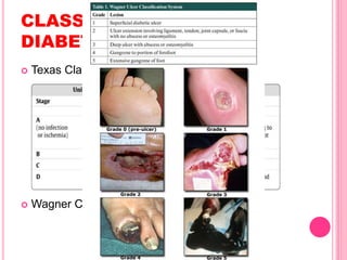 CLASSIFICATION OF
DIABETIC FOOT ULCER
 Texas Classification
 Wagner Classification
 
