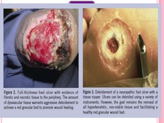 Vascular
perfusion
Debridement
Infection
Control
Off-
loading
Wound
coverage
Treatment of
Charcot foot
Hyperbaric
Oxygen
Treatment
Dietary
Changes
Activity
restriction
Amputation
 