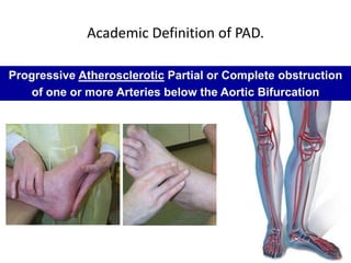 Academic Definition of PAD.
Progressive Atherosclerotic Partial or Complete obstruction
of one or more Arteries below the Aortic Bifurcation
 