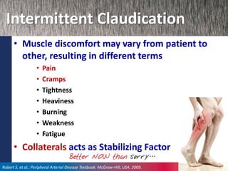 Intermittent Claudication
• Muscle discomfort may vary from patient to
other, resulting in different terms
• Pain
• Cramps
• Tightness
• Heaviness
• Burning
• Weakness
• Fatigue
• Collaterals acts as Stabilizing Factor
Robert S. et al.: Peripheral Arterial Disease Textbook. McGraw-Hill, USA. 2009.
 