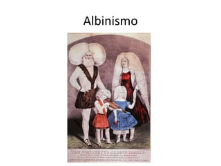Albinismo