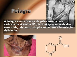 Pelagra A Pelagra é uma doença de pele causada pela carência da vitamina PP (niacina) e/ou aminoácidos essenciais, tais como o triptofanoe uma alimentação deficiente. 