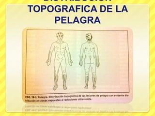 DISTRIBUCION
TOPOGRAFICA DE LA
    PELAGRA
 