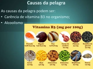 Causas da pelagra
As causas da pelagra podem ser:
• Carência de vitamina B3 no organismo;
• Alcoolismo
 