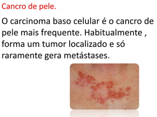 Cancro de pele.
O carcinoma baso celular é o cancro de
pele mais frequente. Habitualmente ,
forma um tumor localizado e só
raramente gera metástases.
 