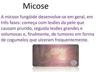 Micose
A micose fungóide desenvolve-se em geral, em
três fases: começa com lesões da pele que
causam prurido, seguida lesões grandes e
volumosas e, finalmente, de tumores em forma
de cogumelos que ulceram frequentemente.
 