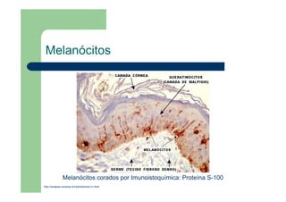 Melanócitos
http://anatpat.unicamp.br/nptmielomen1c.html
Melanócitos corados por Imunoistoquímica: Proteína S-100
 