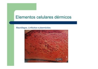 Elementos celulares dérmicos
Macrófagos, Linfócitos e plasmócitos.
 