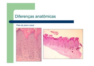 Diferenças anatômicas
Pele de plano nasal
 