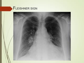 FLEISHNER SIGN
 