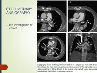 CT PULMONARY
ANGIOGRAPHY
 It is investigation of
choice
 