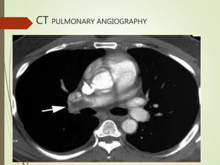 CT PULMONARY ANGIOGRAPHY
 