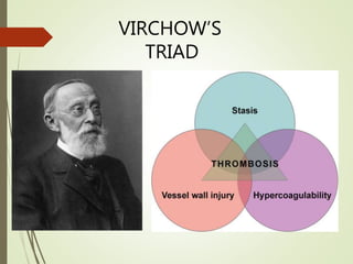 VIRCHOW’S
TRIAD
 