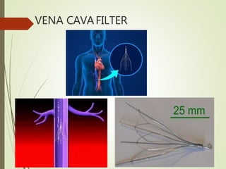 VENA CAVAFILTER
 