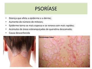 PSORÍASE
• Doença que afeta a epiderme e a derme;
• Aumento do número de mitoses;
• Epiderme torna-se mais espessa e se renova com mais rapidez;
• Acúmulos de áreas esbranquiçadas de queratina descamada;
• Causa desconhecida
 
