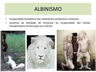 ALBINISMO
• Incapacidade hereditária dos melanócitos produzirem melanina;
• Ausência de atividade da tirosinase ou incapacidade das células
transportarem tirosina para seu interior.
 