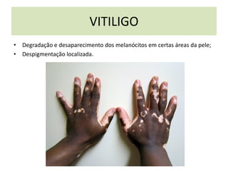 VITILIGO
• Degradação e desaparecimento dos melanócitos em certas áreas da pele;
• Despigmentação localizada.
 