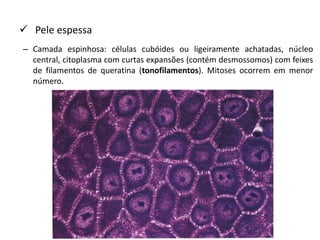  Pele espessa
– Camada espinhosa: células cubóides ou ligeiramente achatadas, núcleo
central, citoplasma com curtas expansões (contém desmossomos) com feixes
de filamentos de queratina (tonofilamentos). Mitoses ocorrem em menor
número.
 