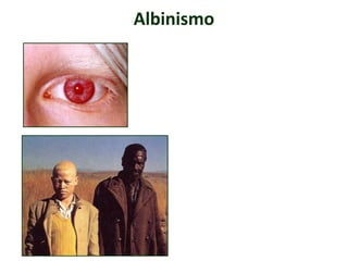 Albinismo
 